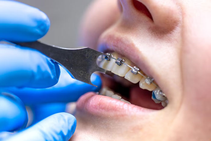 ORTHODONTIC-TREATMENT